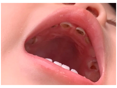河北惟德口腔涂氟流程簡(jiǎn)單，孩子配合度拉滿