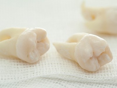 智齒疼了，這牙非拔不可嗎？