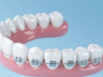 想做牙齒矯正，哪種方案更適合你？