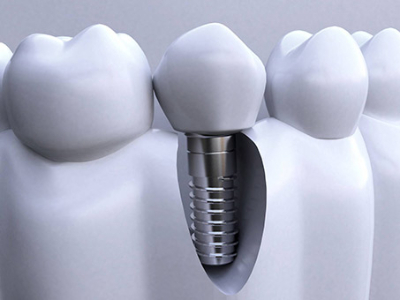 承德種植牙價(jià)格表，2024種植牙多少錢(qián)一顆呢?