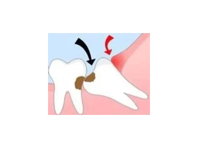 吃完飯后老塞牙？別大意！這可能是你的牙齒在報(bào)警