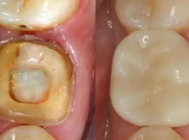 根管治療（抽神經(jīng)）后，為什么一定要做牙冠？