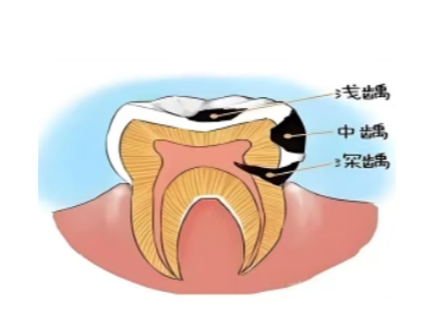 乳牙不是 “過渡品”——保護孩子牙齒從第一顆開始