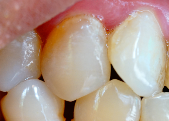 牙齒表面的牙釉質(zhì)掉了還可以修復(fù)嗎？