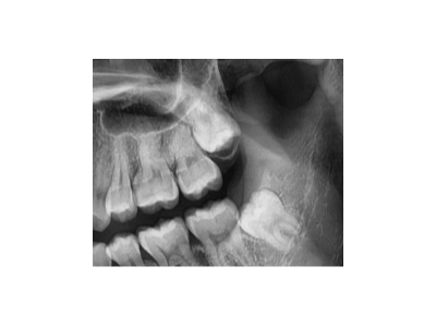 既然「智齒」不宜久留，為什么不能一次性拔掉？