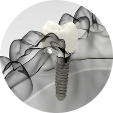術(shù)前研究、模擬提升種植成功率