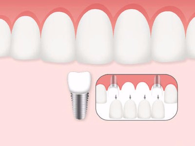 惟德口腔口腔種植怎么樣？惟德口腔就來(lái)為您一一解答