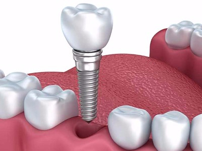 承德種植牙哪個醫(yī)院比較好【答】