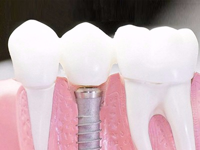 在承德口腔種植齒需要多少錢？惟德口腔一一為您道來(lái)