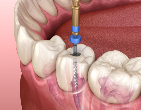 根管治療后的注意事項有哪些？